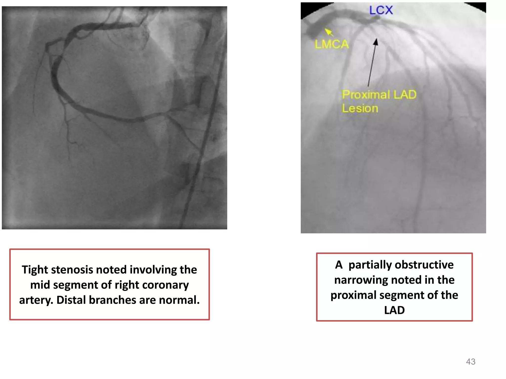 Coronary angiography | PPTX