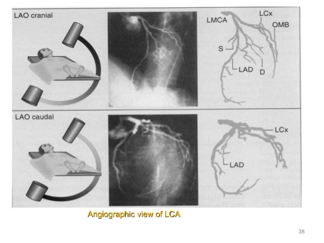 Coronary angiography heart diagram rca 
