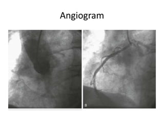 Coronary arteries anomalies | PPTX