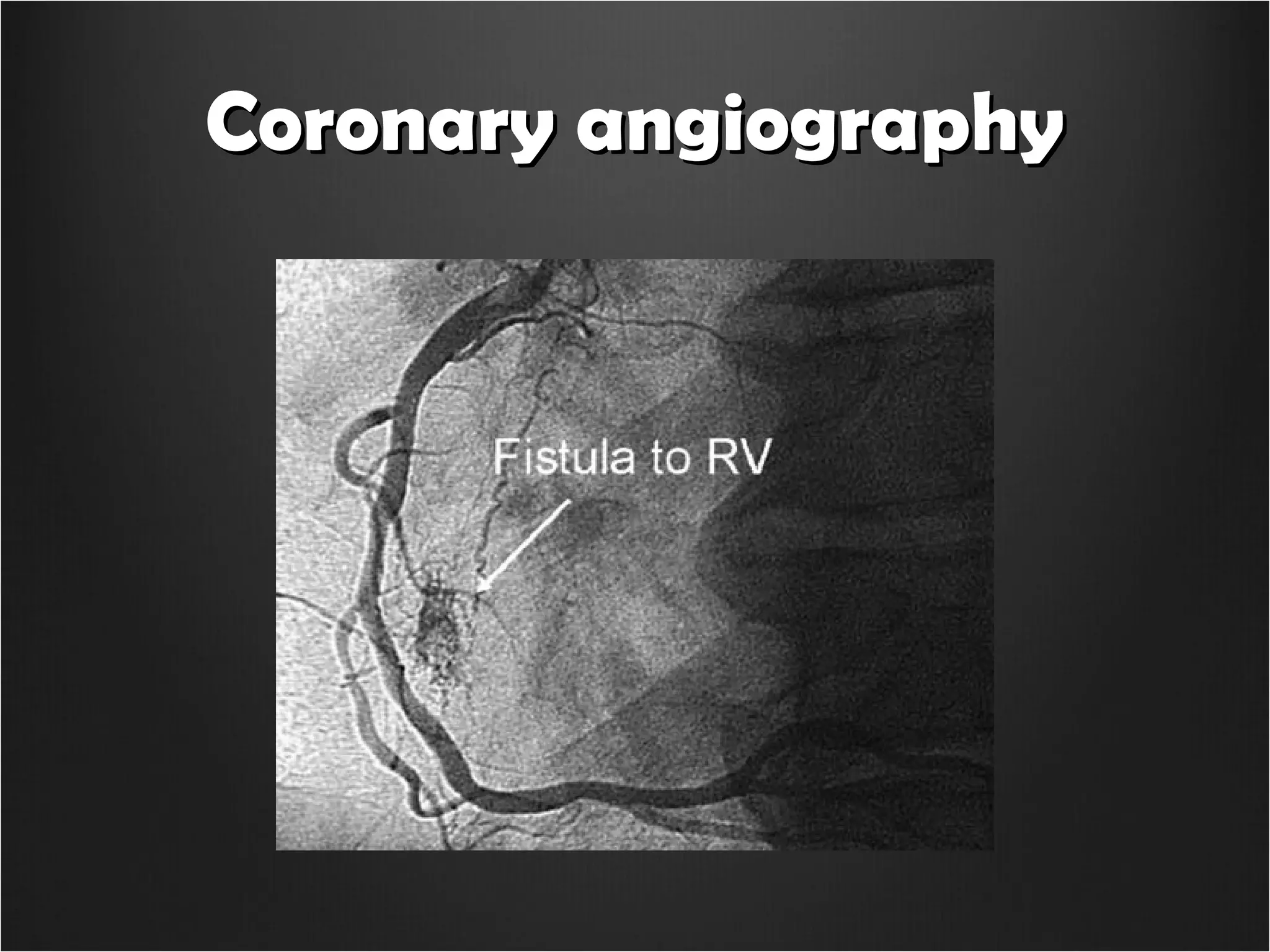 Coronary arterio venous fistula | PPT