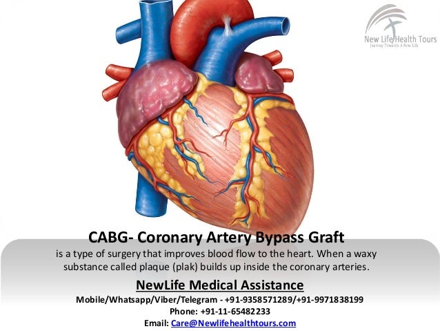 Know About Coronary Artery Bypass Grafting Cabg Best CABG (Coronary