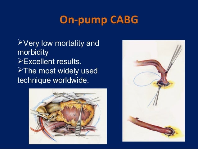 coronary artery bypass graft cabg surgery