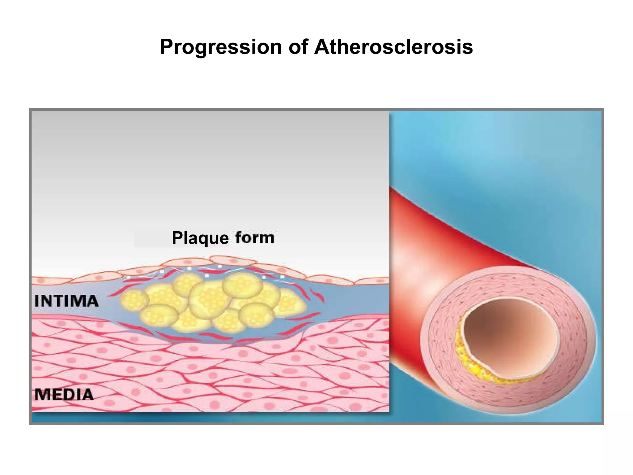 Pathophysiology of Coronary Artery Disease | PPT