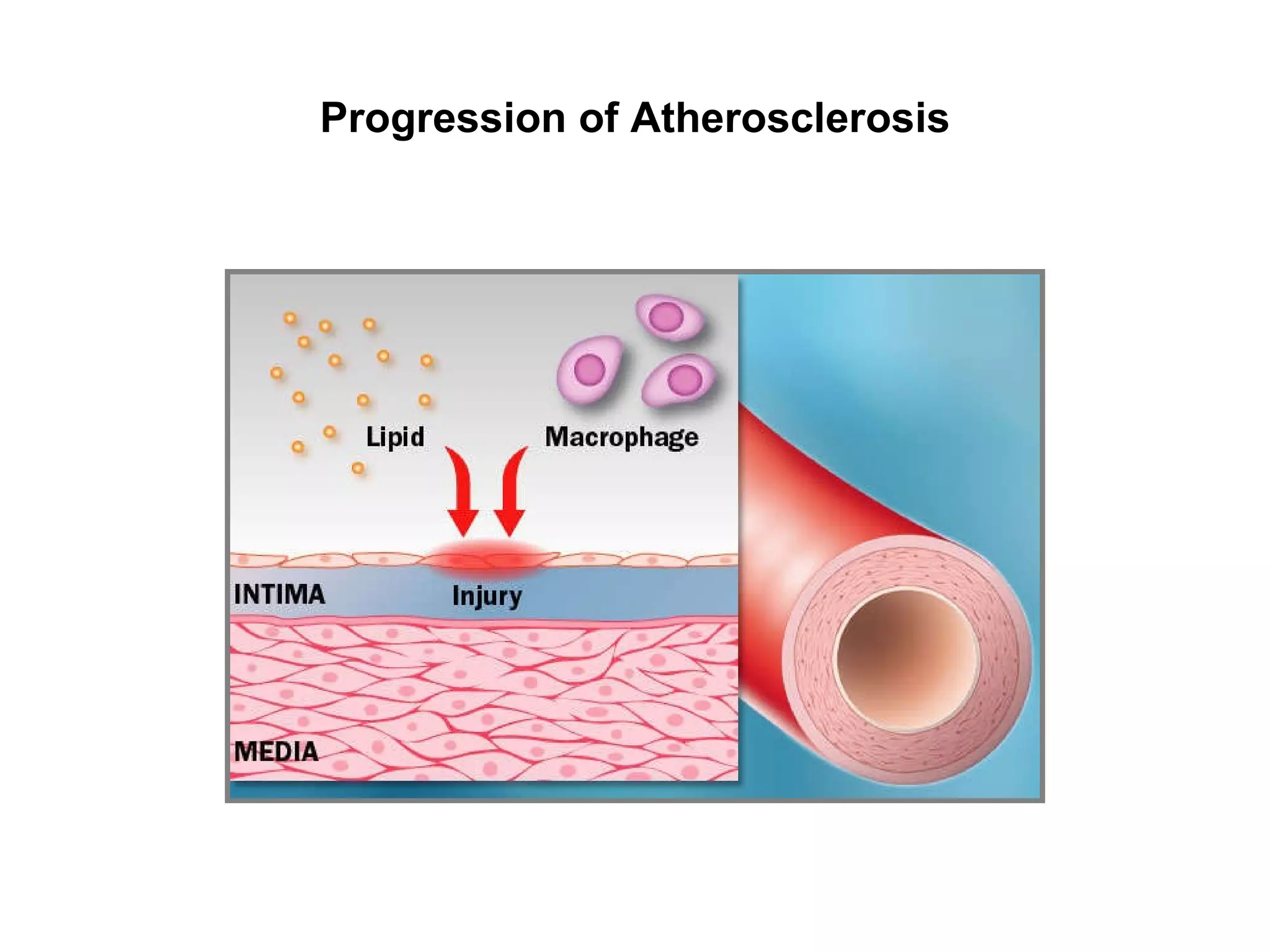 Pathophysiology of Coronary Artery Disease | PPT