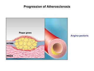 Pathophysiology of Coronary Artery Disease | PPT