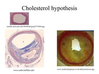 medlib.med.utah.edu/WebPath/jpeg5/CV004.jpg
www.medicalengineer.co.uk/atherosclerosis.jpg
www.smbs.buffalo.edu/
Cholesterol hypothesis
 
