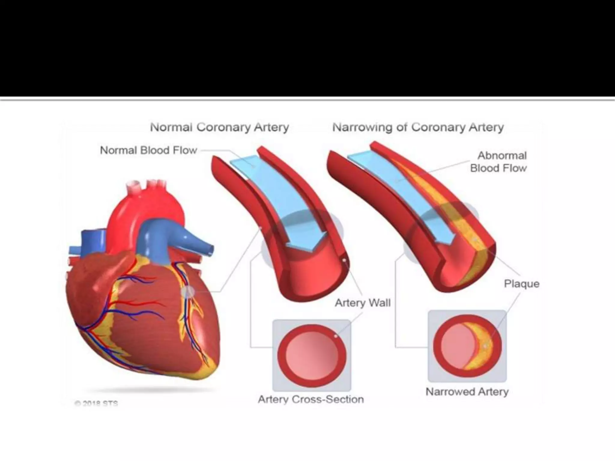 Coronary artery disease | PPTX