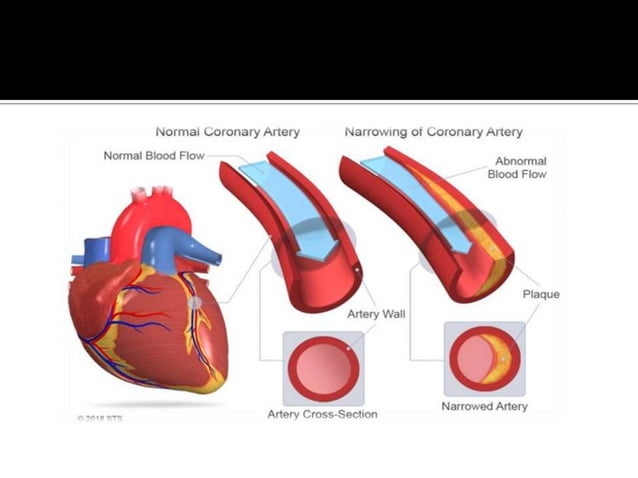 Coronary artery disease | PPTX | Heart and Cardiovascular Diseases ...