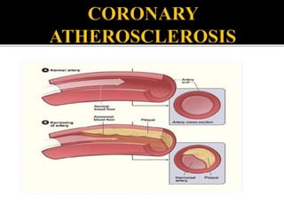 Coronary artery disease | PPTX