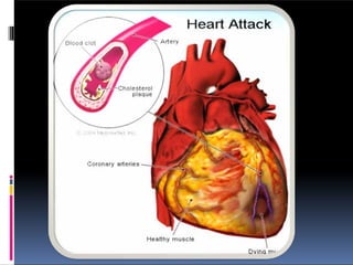 coronary artery disease and its prevention. | PPTX