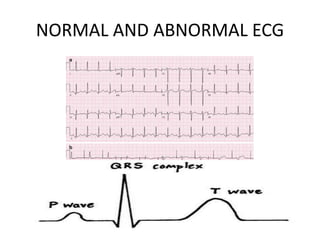 NORMAL AND ABNORMAL ECG
 