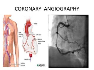 CORONARY ANGIOGRAPHY
 