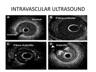 INTRAVASCULAR ULTRASOUND
 