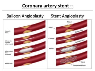 Coronary artery stent –
 