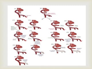 Perforation Classification CORONARY ARTERY PERFORATIONS ppt.pptx