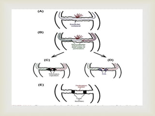 Perforation Classification CORONARY ARTERY PERFORATIONS ppt.pptx