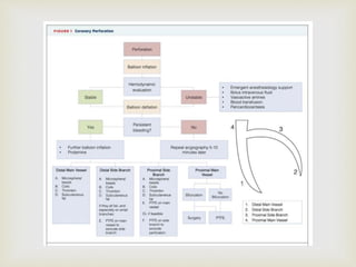 Perforation Classification CORONARY ARTERY PERFORATIONS ppt.pptx