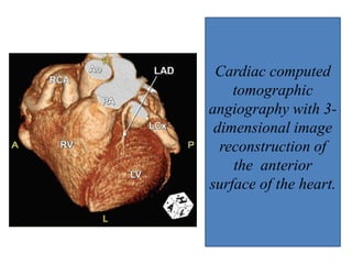 coronarycameralfistula-170307133357.pdf