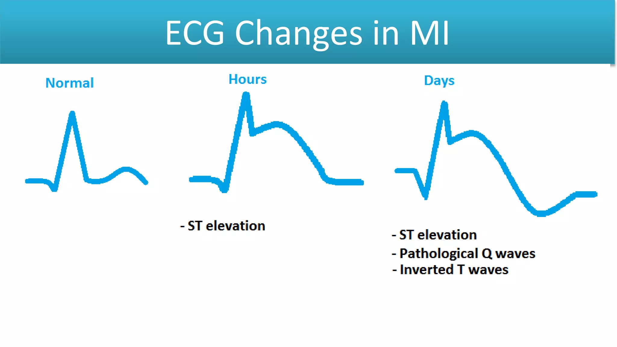 ECG Changes in MI
 
