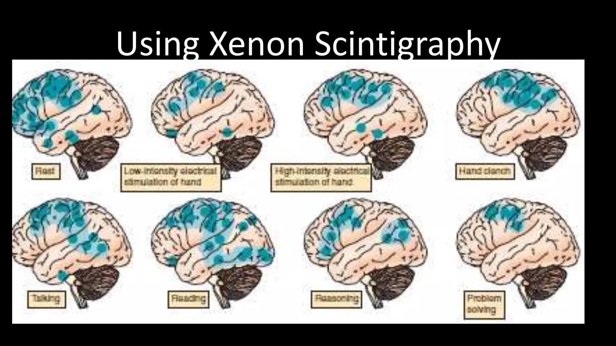 Using Xenon Scintigraphy
 