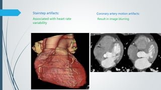 Stairstep artifacts:
Associated with heart rate
variability
Coronary artery motion artifacts:
Result in image blurring
 