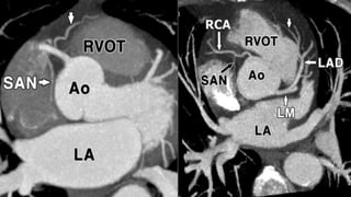 Coronary CTA | PPTX