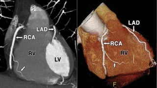 Coronary CTA | PPTX