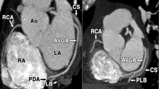 Coronary CTA | PPTX