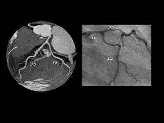 Coronary CTA: The test of choice for obstructive CAD. | PPTX