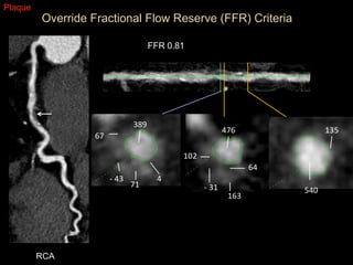 Coronary CTA: The test of choice for obstructive CAD. | PPTX