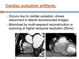 Cardiac pulsation artifacts:
 Occurs due to cardiac pulsation, shows
disconnect in lateral reconstructed images.
 Minimized by multi-segment reconstruction or
scanning at higher temporal resolution (50ms)
 