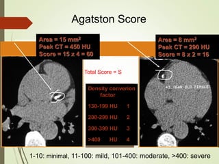 Density converion
factor
130-199 HU 1
200-299 HU 2
300-399 HU 3
>400 HU 4
Area = 15 mm2
Peak CT = 450 HU
Score = 15 x 4 = 60
Area = 8 mm2
Peak CT = 290 HU
Score = 8 x 2 = 16
Total Score = S
Agatston Score
1-10: minimal, 11-100: mild, 101-400: moderate, >400: severe
 