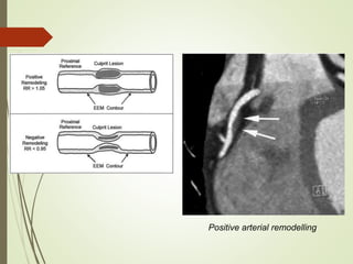 Positive arterial remodelling
 