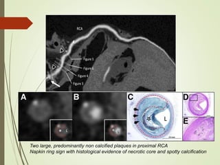 Two large, predominantly non calcified plaques in proximal RCA
Napkin ring sign with histological evidence of necrotic core and spotty calcification
 