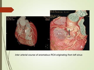 Inter arterial course of anomalous RCA originating from left sinus
 