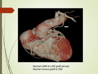 Normal LIMA to LAD graft (arrow)
Normal venous graft to OM
 