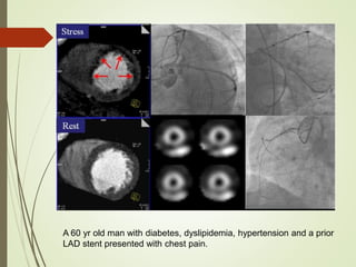A 60 yr old man with diabetes, dyslipidemia, hypertension and a prior
LAD stent presented with chest pain.
 