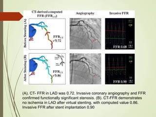 (A). CT- FFR in LAD was 0.72. Invasive coronary angiography and FFR
confirmed functionally significant stenosis. (B). CT-FFR demonstrates
no ischemia in LAD after virtual stenting, with computed value 0.86.
Invasive FFR after stent implantation 0.90
 