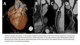 CCTA of a 61 year old women. A) 3D volume rendered reconstruction of the heart and the coronaries. The coronary
arteries can be seen in the 3D reconstruction. B) Reconstruction of the right coronary artery (RCA) without CAD. C)
Reconstruction of the left anterior descending artery of the same patient, also without stenosis. D) Circumflex (CX)
reconstruction, not showing any disease.
 