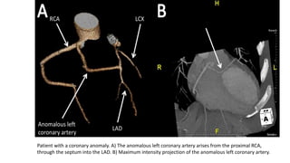 Patient with a coronary anomaly. A) The anomalous left coronary artery arises from the proximal RCA,
through the septum into the LAD. B) Maximum intensity projection of the anomalous left coronary artery.
 