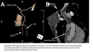 Evaluation after bypass-surgery, same patient as in figure 4. A) The distal left internal mammary artery (LIMA)
is anastomosed with the proximal LAD at the location of the former anomalous left coronary artery. B) The
graft and distal LAD show good contrast filling.
 