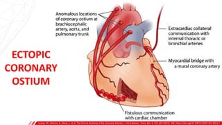 ECTOPIC
CORONARY
OSTIUM
Loukas, M., Sharma, A., Blaak, C. et al. The Clinical Anatomy of the Coronary Arteries. J. of Cardiovasc. Trans. Res. 6, 197–207 (2013). DOI: https://doi.org/10.1007/s12265-013-9452-5
 