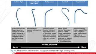 GUIDE CATHETER SHAPES
Intervent Cardiol Clin 4 (2015) 145–159. DOI: http://dx.doi.org/10.1016/j.iccl.2014.12.001
 