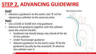 STEP 2. ADVANCING GUIDEWIRE
Brilakis, E. (2020). Manual of percutaneous coronary interventions: a step-by-step approach. Academic Press.
Goal?
• Advance a guidewire to the aortic root  rail for
advancing a catheter to the coronary ostia
How?
• Use a 0.035 or 0.038 inch J-tip guidewire
• Advance the guidewire together with the catheter
(over the arterial sheath)
• Guidewire tip should always stay ahead of the tip
of the catheter
• Under fluoroscopic guidance
• Advance guidewire to the aortic cusps  fix the
guidewire (usually by the assistant)  advance
the catheter over it
 