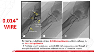 0.014”
WIRE
Moscucci, M. (2013). Grossman & Baim's cardiac catheterization, angiography, and intervention. Lippincott Williams & Wilkins.
Navigating a radial loop using an 0.014 inch guidewire and then exchange for
an 0.035 inch guidewire
 The loop usually straightens as the 0.035 inch guidewire passes through or
with gentle pullback and counterclockwise torque of the entire system
 