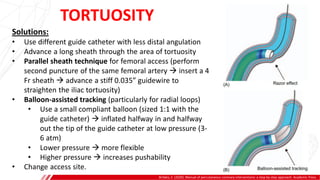 Brilakis, E. (2020). Manual of percutaneous coronary interventions: a step-by-step approach. Academic Press.
Solutions:
• Use different guide catheter with less distal angulation
• Advance a long sheath through the area of tortuosity
• Parallel sheath technique for femoral access (perform
second puncture of the same femoral artery  insert a 4
Fr sheath  advance a stiff 0.035” guidewire to
straighten the iliac tortuosity)
• Balloon-assisted tracking (particularly for radial loops)
• Use a small compliant balloon (sized 1:1 with the
guide catheter)  inflated halfway in and halfway
out the tip of the guide catheter at low pressure (3-
6 atm)
• Lower pressure  more flexible
• Higher pressure  increases pushability
• Change access site.
TORTUOSITY
 