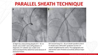 EuroIntervention 2014;10:231-235. DOI: 10.4244/EIJV10I2A37
PARALLEL SHEATH TECHNIQUE
A) Right iliac artery kinking despite 8 Fr - 45 cm
sheath and a 0.035” extra-stiff guidewire. A
diagnostic 5 Fr catheter was unable to be
advanced beyond the abdominal aorta because of
excessive friction.
B) A second long 5 Fr - 45 cm sheath parallel to the 8
Fr sheath and a stiff 0.035” guidewire via the 5 Fr
sheath straightened the artery. The angiography and
intervention were finished successfully without major
friction.
 