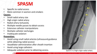 Brilakis, E. (2020). Manual of percutaneous coronary interventions: a step-by-step approach. Academic Press.
• Specific to radial access
• More common in women and smokers
Causes:
• Small radial artery size
• High origin radial artery
• Radial artery tortuosity
• Multiple needle passes to obtain access
• Extensive catheter manipulations
• Multiple catheter exchanges
• Inadequate sedation
Prevention:
• Avoid using small radial arteries (ultrasound guidance
while obtaining radial access)
• Vasodilator administration after sheath insertion
• Avoid using large catheters
• Adequate sedation prior to obtaining access.
SPASM
Spasm in a high origin radial artery
 