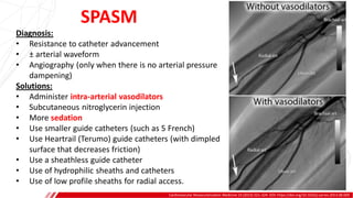 Cardiovascular Revascularization Medicine 14 (2013) 321–324. DOI: https://doi.org/10.1016/j.carrev.2013.08.009
Diagnosis:
• Resistance to catheter advancement
• ± arterial waveform
• Angiography (only when there is no arterial pressure
dampening)
Solutions:
• Administer intra-arterial vasodilators
• Subcutaneous nitroglycerin injection
• More sedation
• Use smaller guide catheters (such as 5 French)
• Use Heartrail (Terumo) guide catheters (with dimpled
surface that decreases friction)
• Use a sheathless guide catheter
• Use of hydrophilic sheaths and catheters
• Use of low profile sheaths for radial access.
SPASM
 