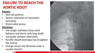 Brilakis, E. (2020). Manual of percutaneous coronary interventions: a step-by-step approach. Academic Press.
Causes:
• Very tall patients
• Severe subclavian or iliac/aortic
tortuosity
• Distal radial access
Solutions:
• Use longer catheters (may need
balloons and stents with long shaft)
• Use guide catheter extensions
• Parallel sheath technique (to straighten
the artery)
• Change access site (femoral route is
usually shorter)
FAILURE TO REACH THE
AORTIC ROOT
 